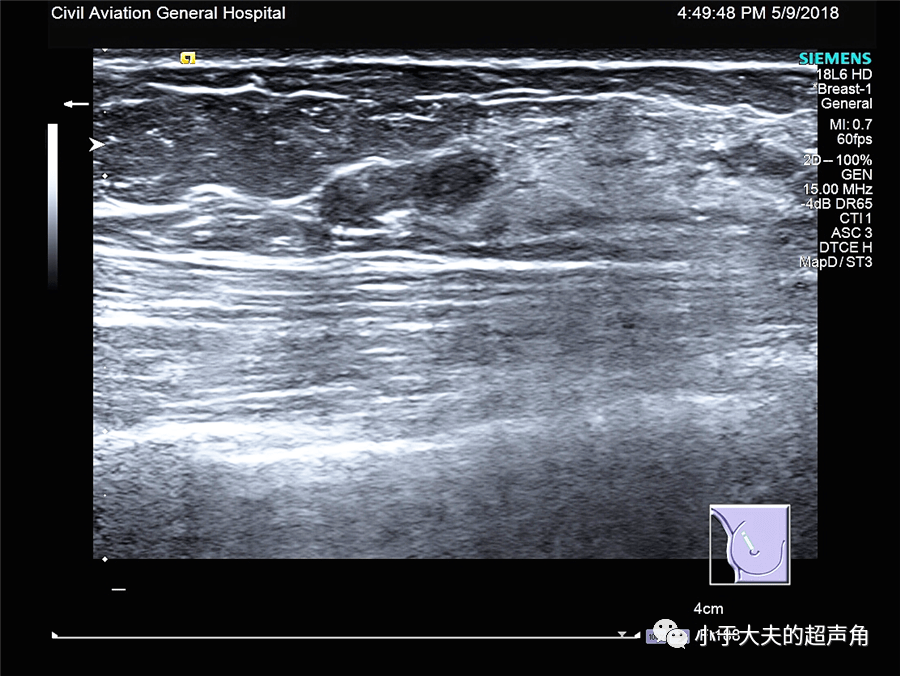 >>>新年好<<< 超声随响 第43期 乳腺叶状肿瘤 =