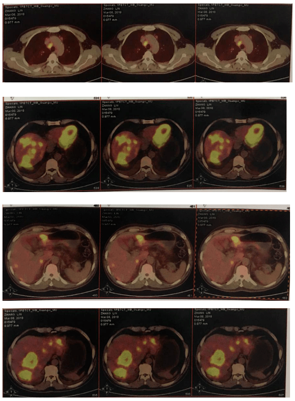 胃癌ct诊断报告图片图片