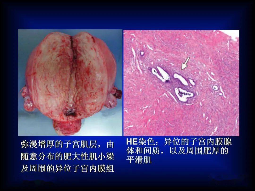 症状:下腹痛,经血过多和子宫增大病理特征:子宫肌层内存在内膜组织