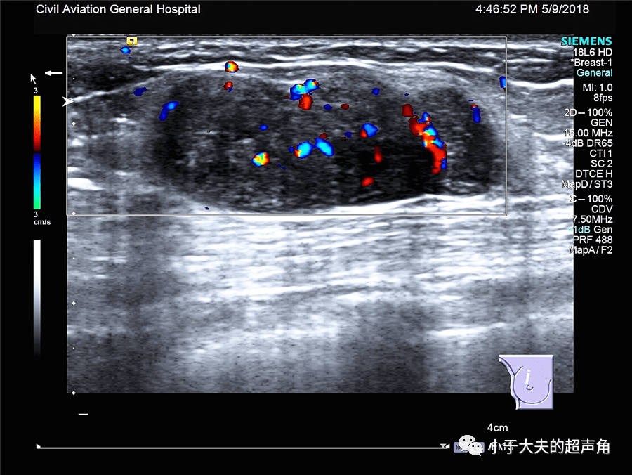 >>>新年好<<< 超声随响 第43期 乳腺叶状肿瘤 =
