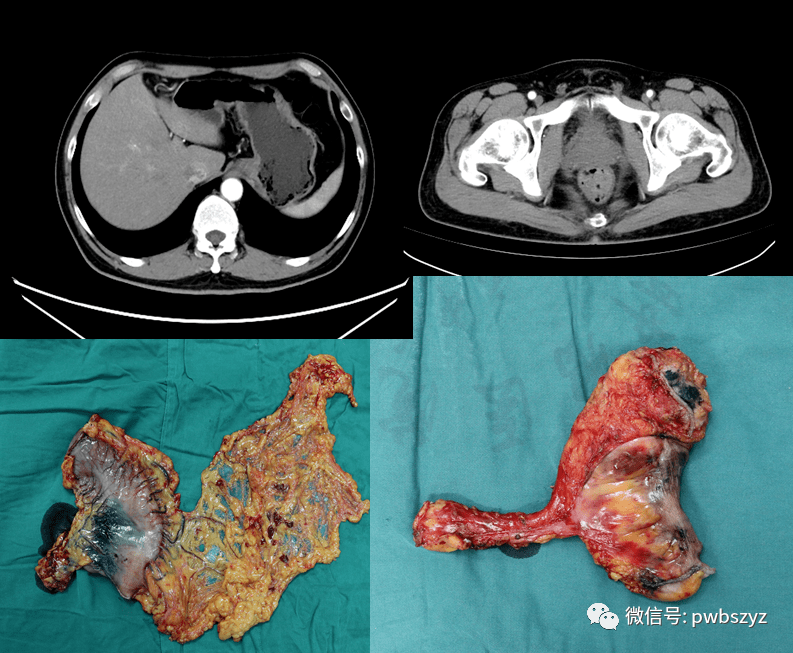 十四:腹膜后肿瘤切加部分腹主动脉切 人工血管置换术不像"千篇一律"的