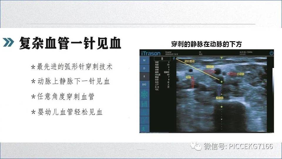 都2021年了,picc选择什么样的置管工具好?