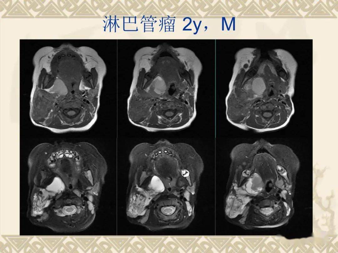 腮腺解剖及病变影像学表现