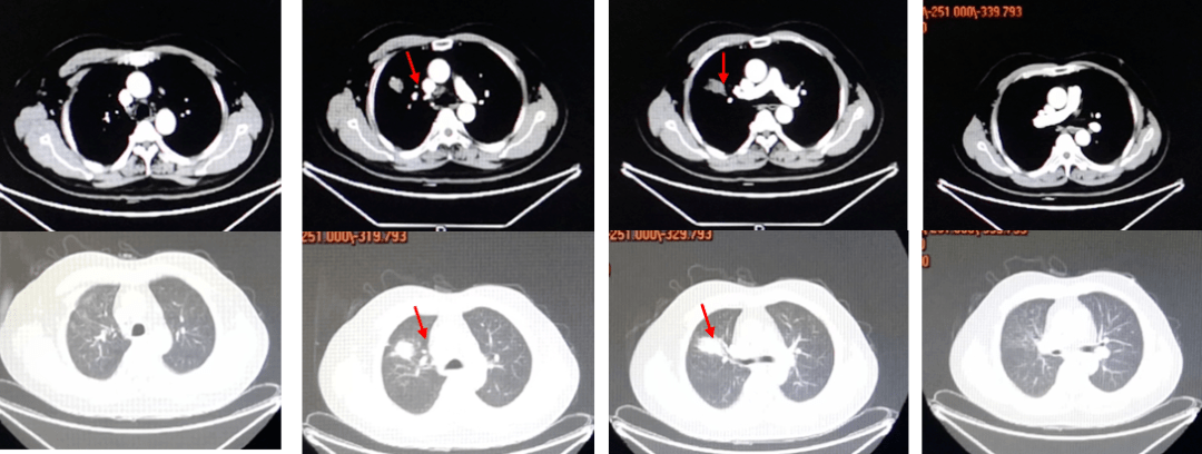 胸部ct:右肺上叶前段肿物长径41cm,余无明显变化,如图5所示