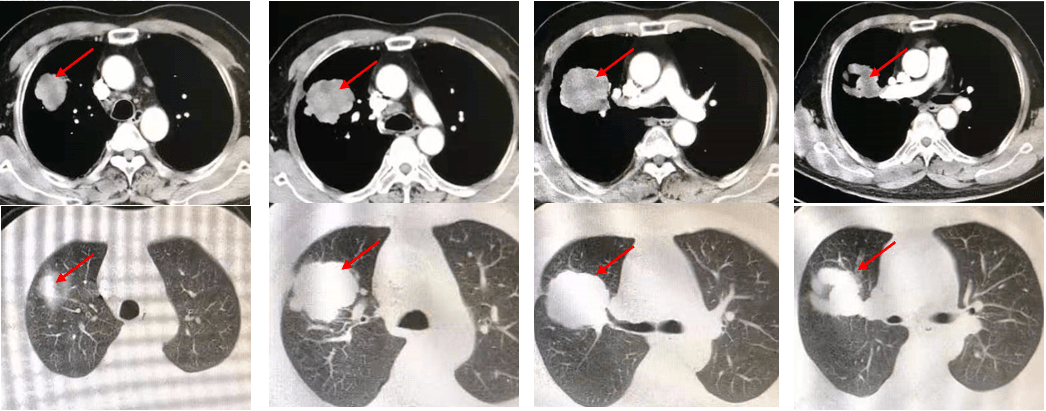 胸部增强ct(2020年1月31日):右肺上叶前段软组织肿物(5.