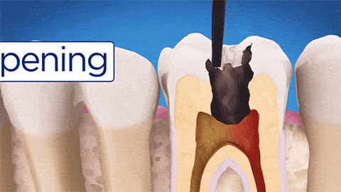 根管治疗管用吗?