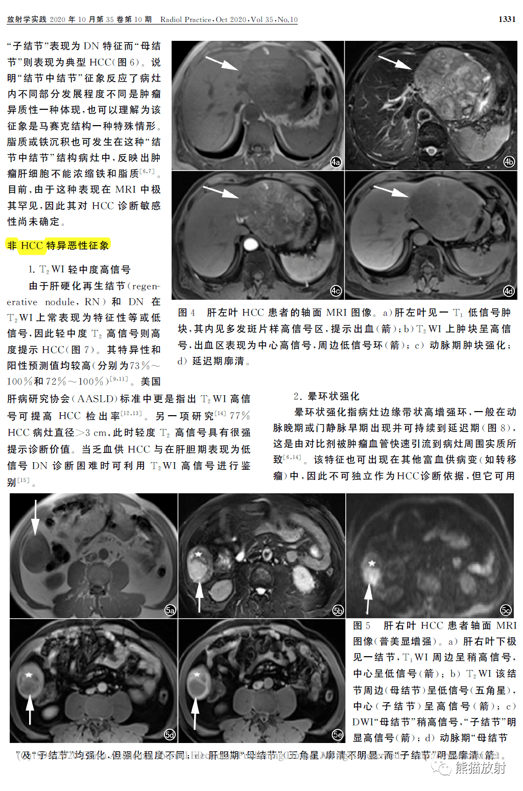 肝脏影像报告和数据系统肝癌mri辅助征象解析