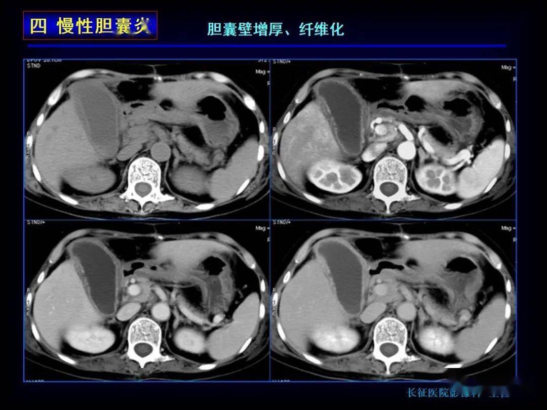 12种胆囊疾病的影像诊断与鉴别