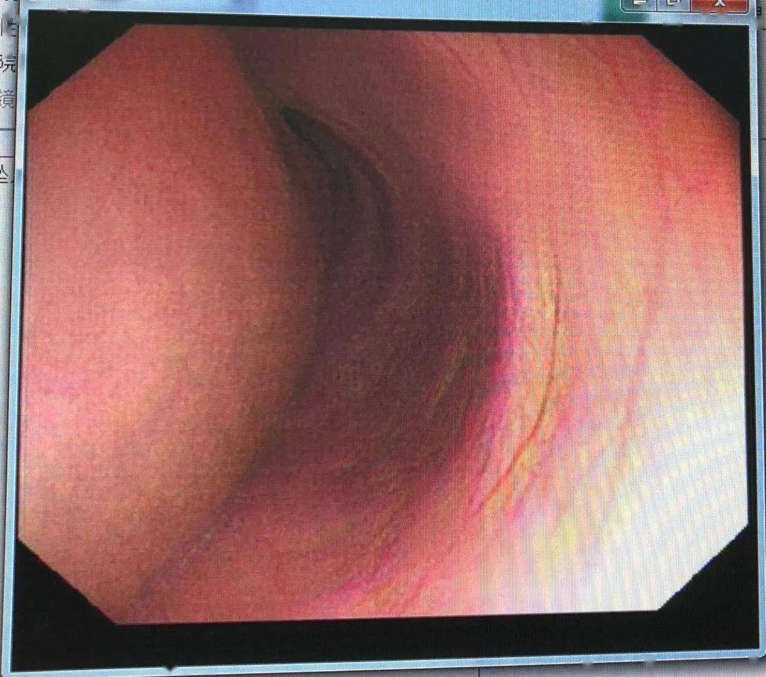 入院后立即做了胃镜检查,发现a先生的整个食管都呈现隆起状,起初还