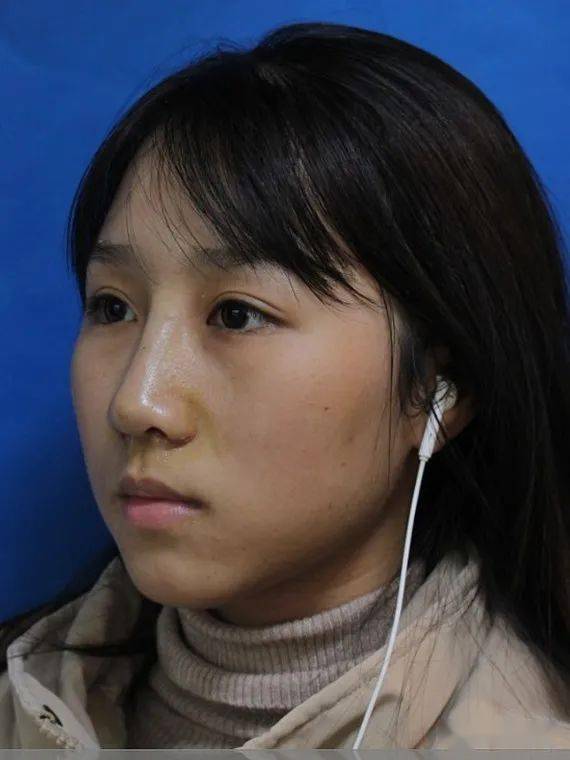 膨体垫鼻根,鼻梁缩窄,耳软骨鼻中隔延长,耳软骨垫鼻尖