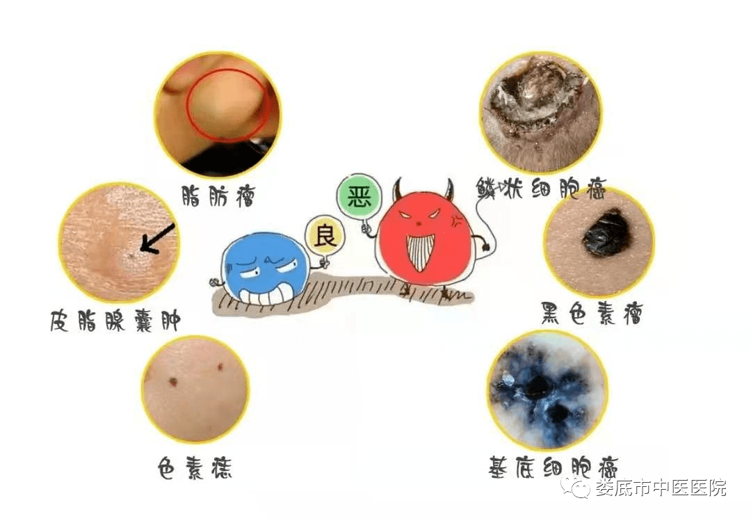 常见的体表肿物种类繁多,有良性,恶性之分,以良性多见,恶性体表肿瘤