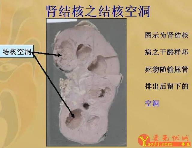 健康科普十说说肺外结核