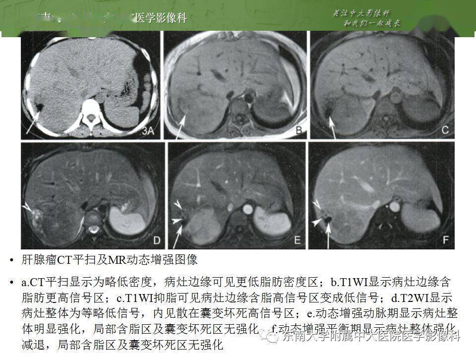 含脂肝细胞肝癌影像表现