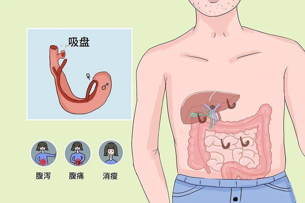 农民,渔民要注意这种寄生虫病!_手机搜狐网