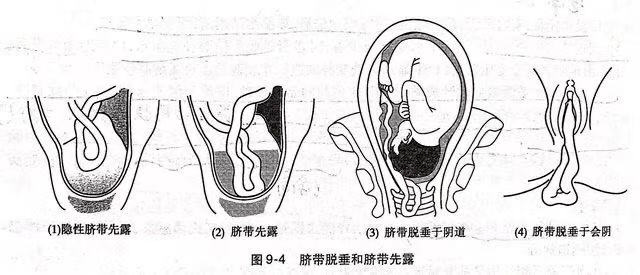 保健院产房内的待产室工作虽忙碌却井井有条的进行,待产的某孕妇于10