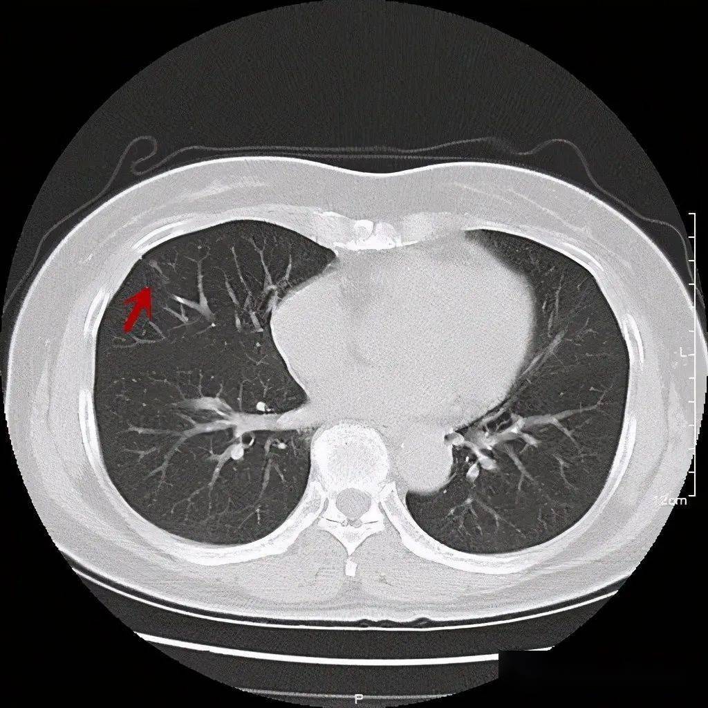 警惕持续存在的肺斑片影!它不一定是炎症,更可能是肺癌
