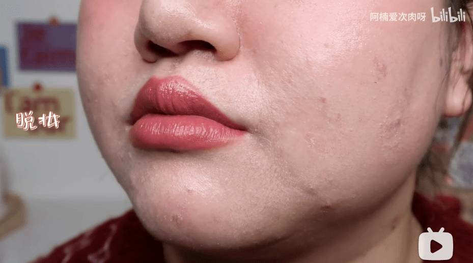唇周的部分也很斑驳,眼下也有卡纹的现象.