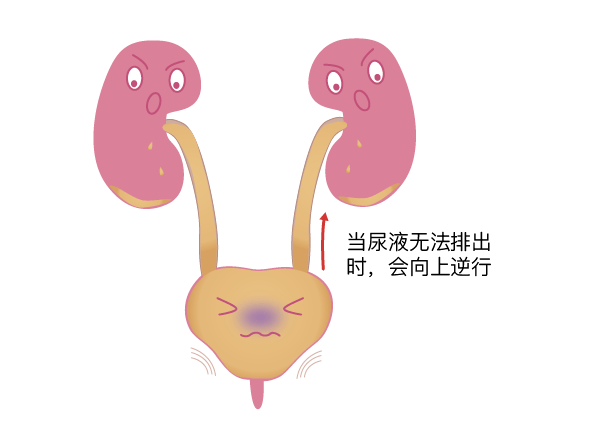 引起的尿路出口梗阻,还有一些神经系统方面的疾病引起的排尿功能障碍