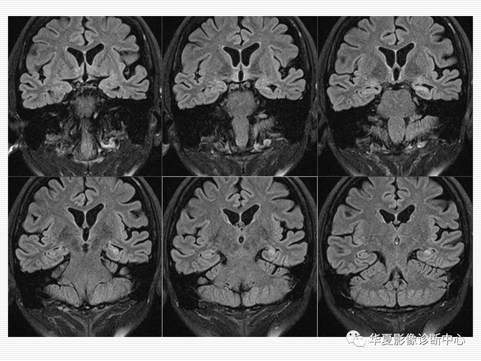关于海马硬化的影像诊断