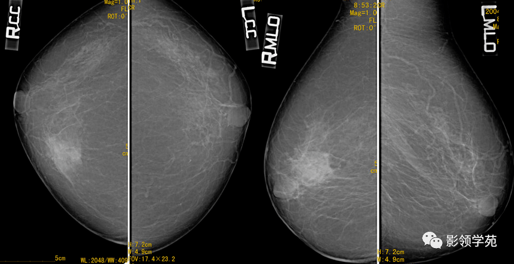 乳腺常見良性腫瘤及腫瘤樣病變影像診斷