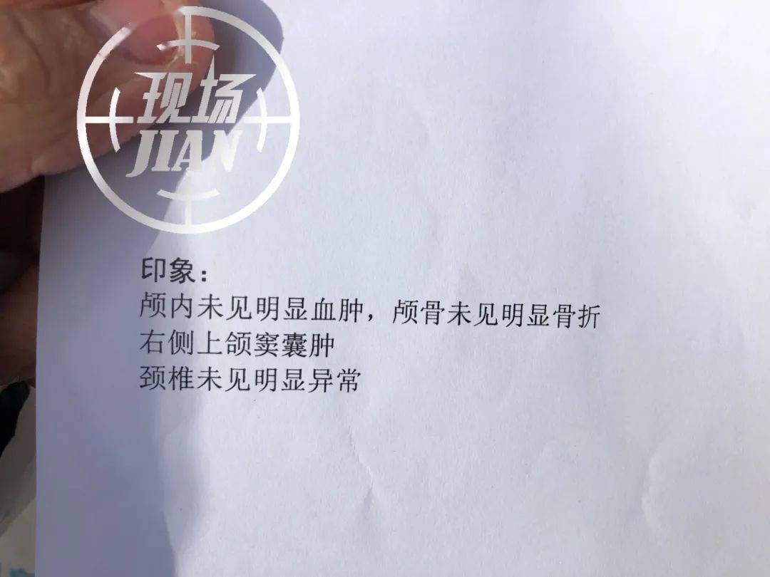 干净,去医院拍了片子,显示右侧上颌窦囊肿,医生说假如有轻微脑震荡