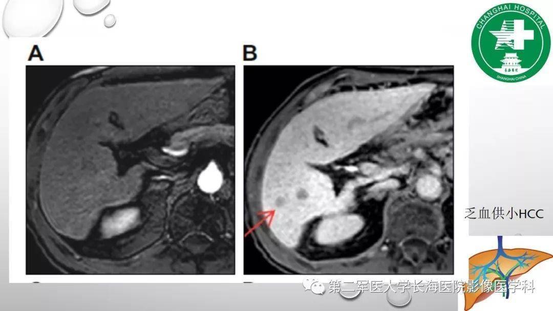 普美显丨肝胆特异性MRI对比剂-钆塞酸二钠Gd-EOB-DTPA-搜狐大视野-搜狐新闻