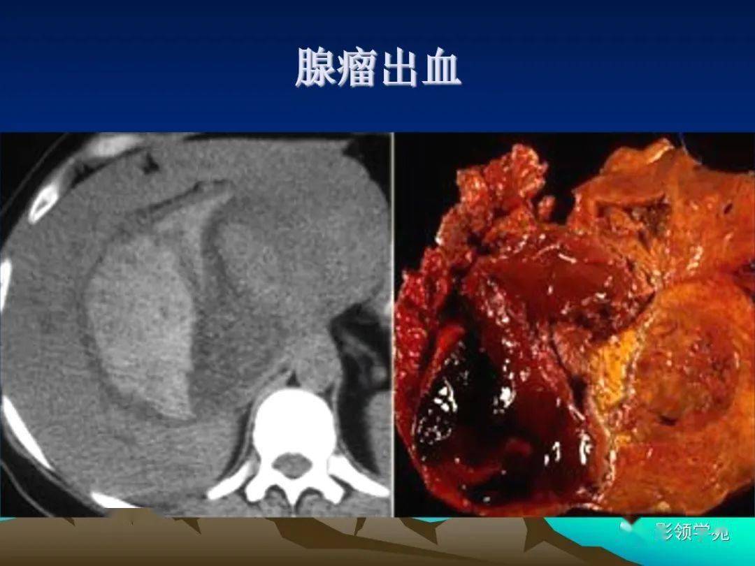肝细胞腺瘤ha的影像学表现