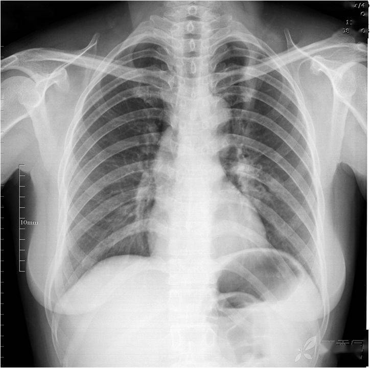 基础干货什么是平片ct的伪影与假象