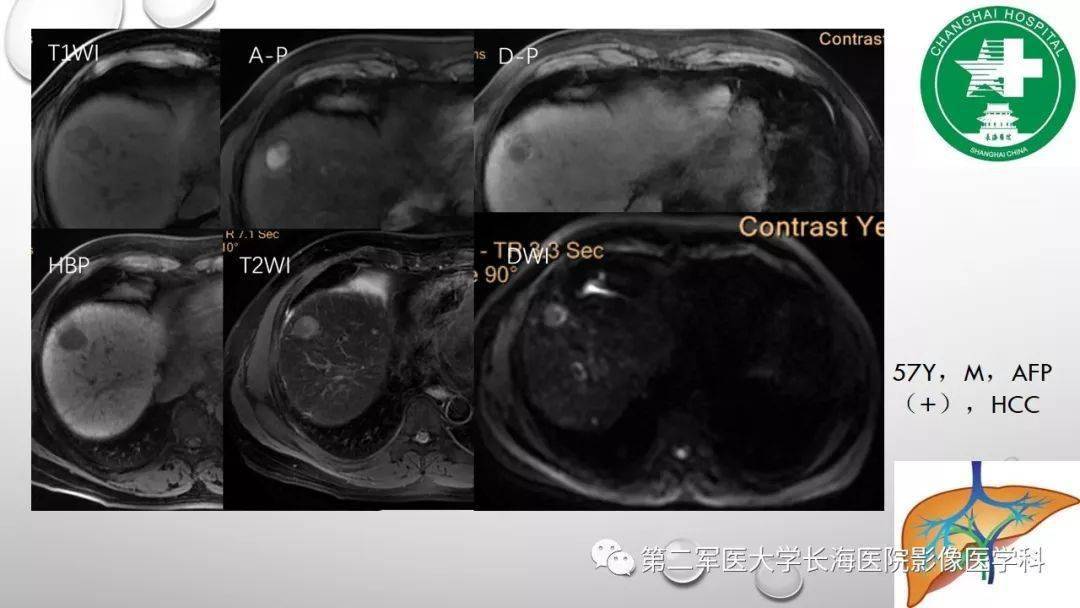 普美显丨肝胆特异性MRI对比剂-钆塞酸二钠Gd-EOB-DTPA_肝脏