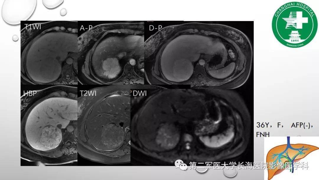 普美显丨肝胆特异性MRI对比剂-钆塞酸二钠Gd-EOB-DTPA_肝脏