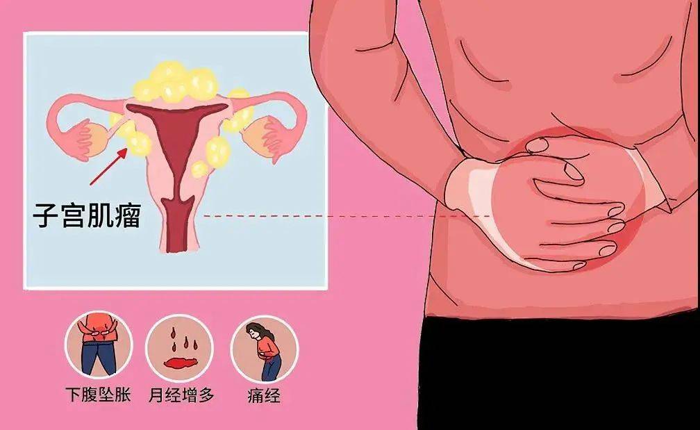 普罗科普聚焦超声无创治疗一网打尽子宫肌瘤分型