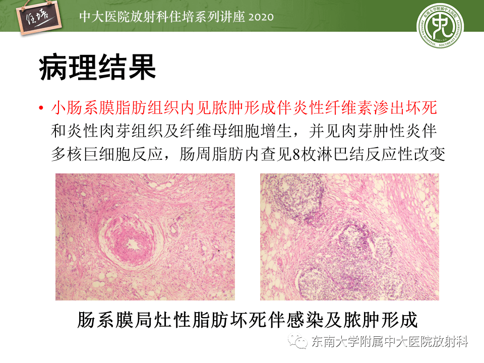【中大放射住培系列讲座】腹部脂肪坏死的影像诊断及鉴别_手机搜狐网