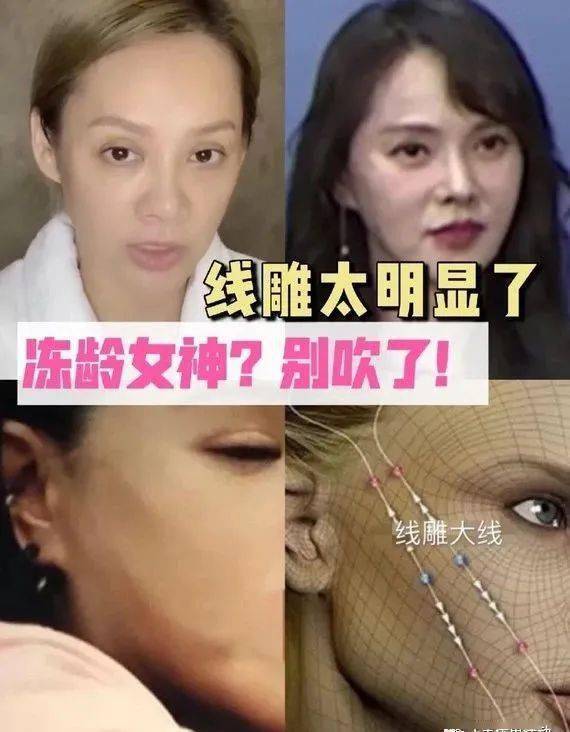 伊能静做了线雕抗衰然后跟大家说做的是热玛吉?_手机搜狐网