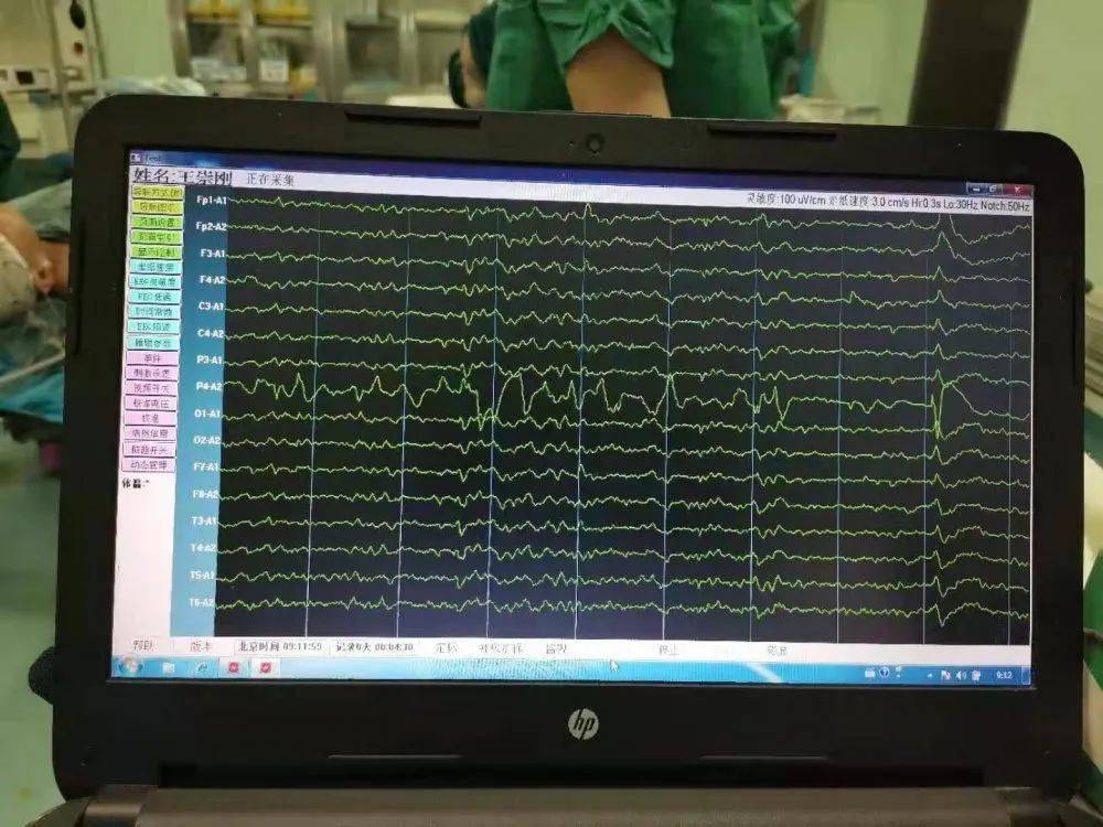 術前腦電圖術後腦電圖孔軍主任介紹,我國為癲癇發病大國,臨床上大體將