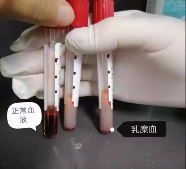 爱吃肥肉73岁娭毑身上抽出白色牛奶血图