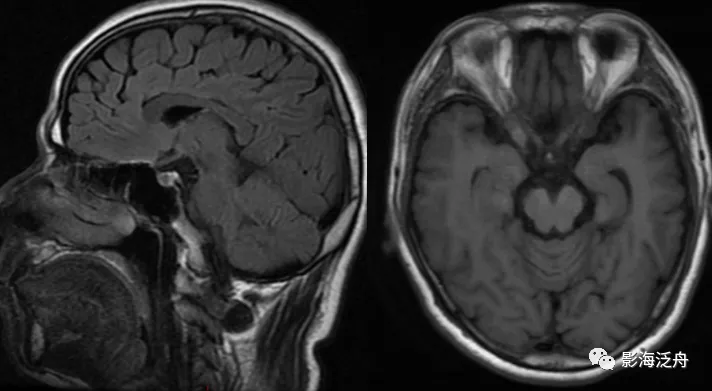 颅脑mr平扫中极易漏诊的点