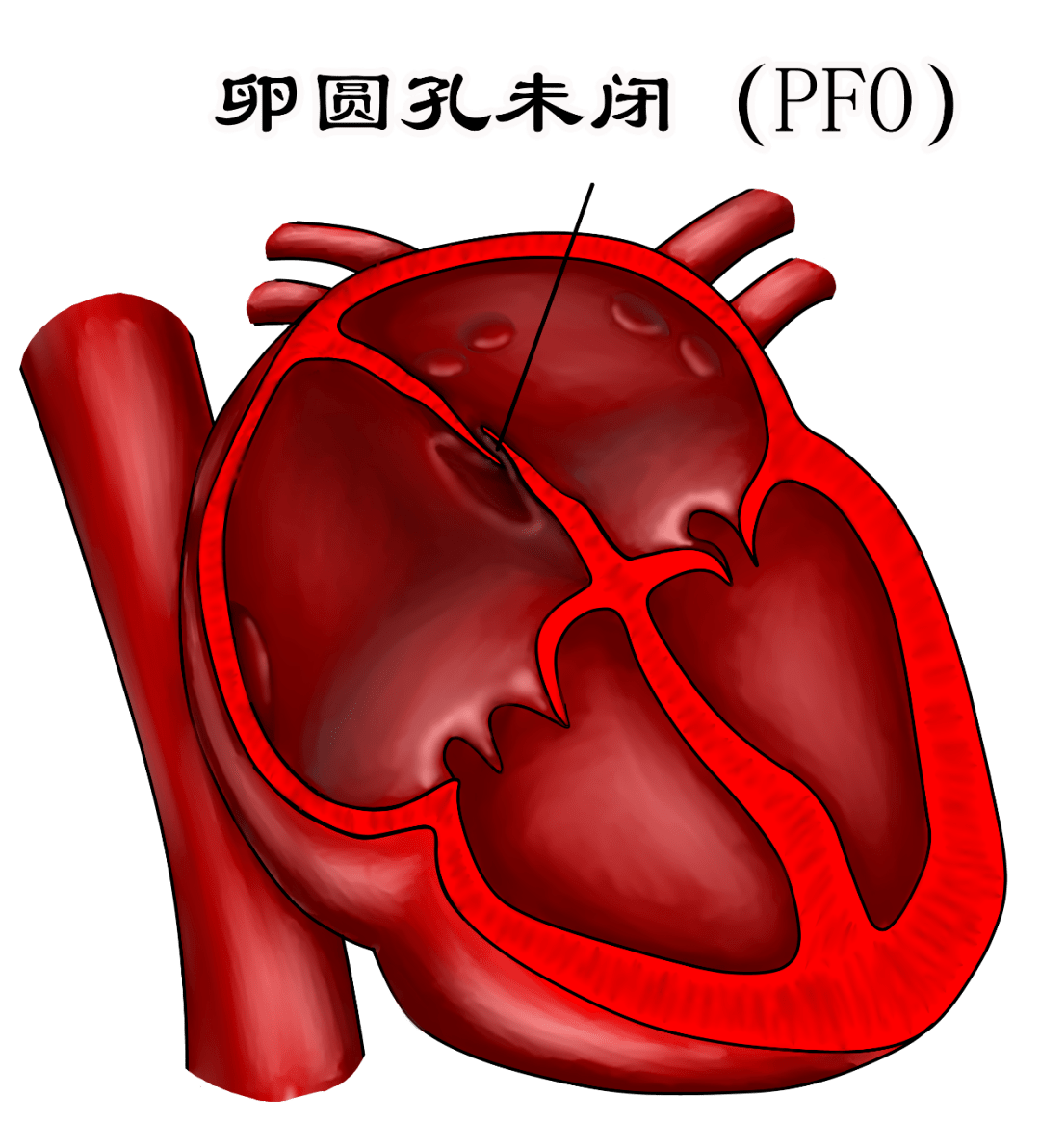 痛起来 生不如死 的偏头痛 很多人终于能找到原因了 患者