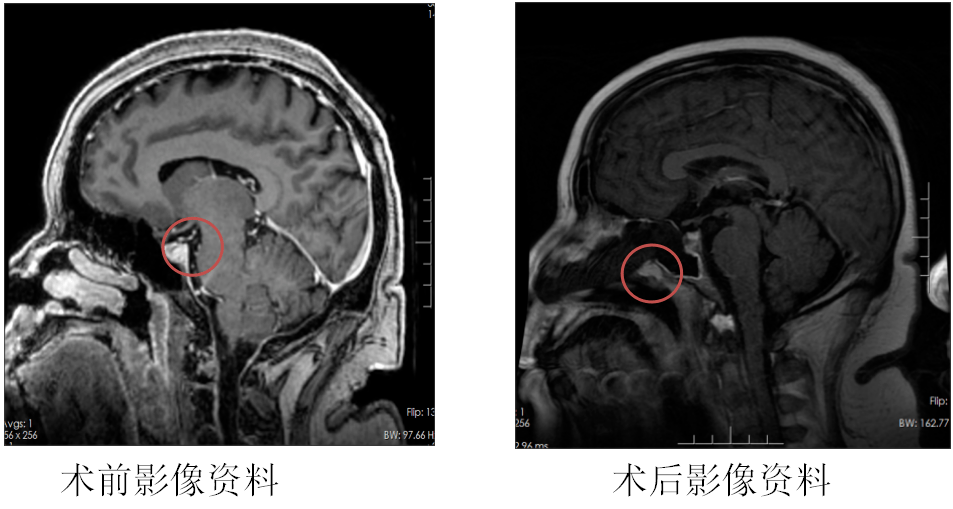 征得患者及家属同意后,金鑫团队为患者实施"内镜经鼻蝶鞍区病损切除术