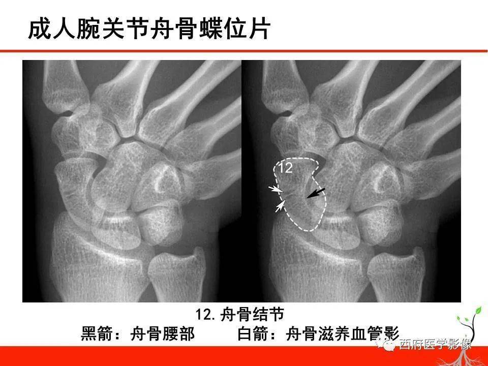 成人腕關節外傷x線診斷