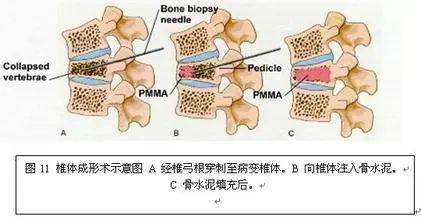 椎體內置入可膨脹性擴骨球囊,然後向氣囊內注入骨水泥的一種微創脊椎