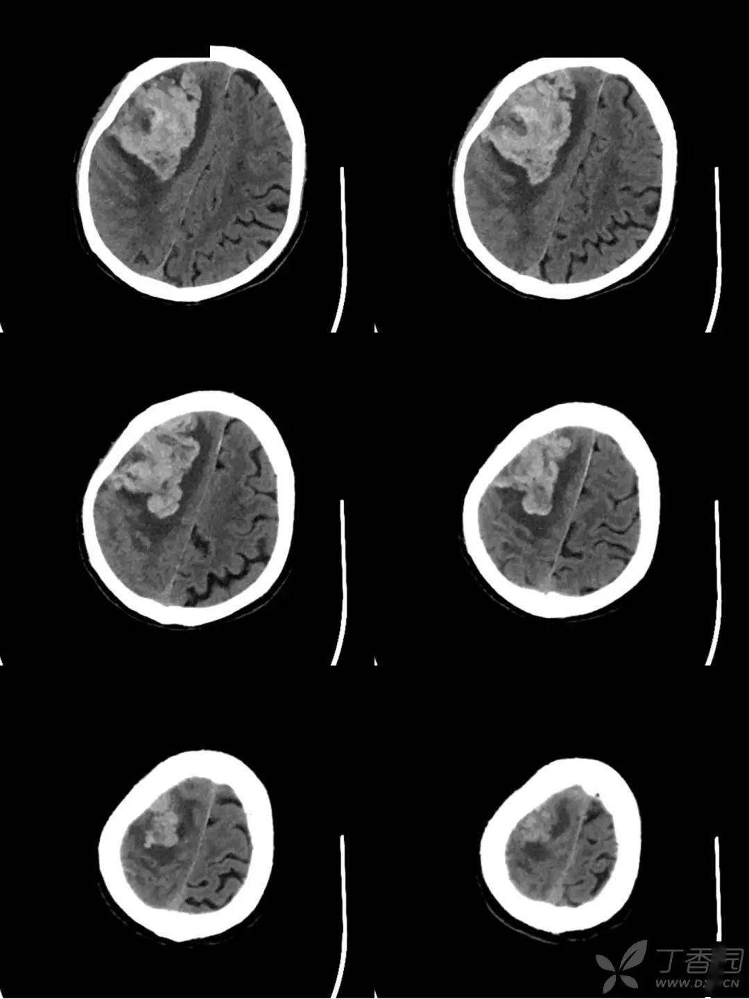 患者脑梗死在卫生院溶栓,为何多方治疗后病情加重?