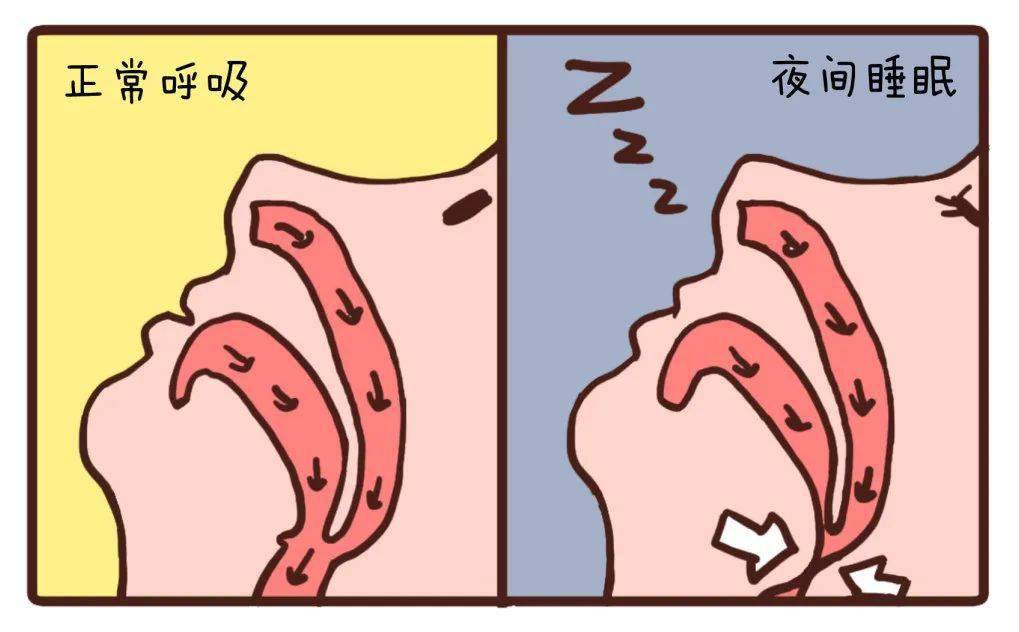 爱打呼的男士注意了呼噜也分良恶性