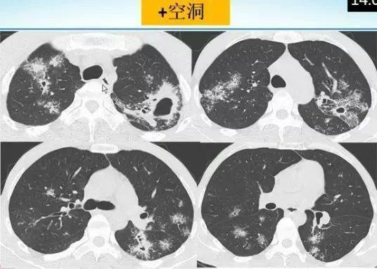 肺部烟花征的影像表现与鉴别诊断