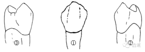 各个牙体雕刻之基本形态要求