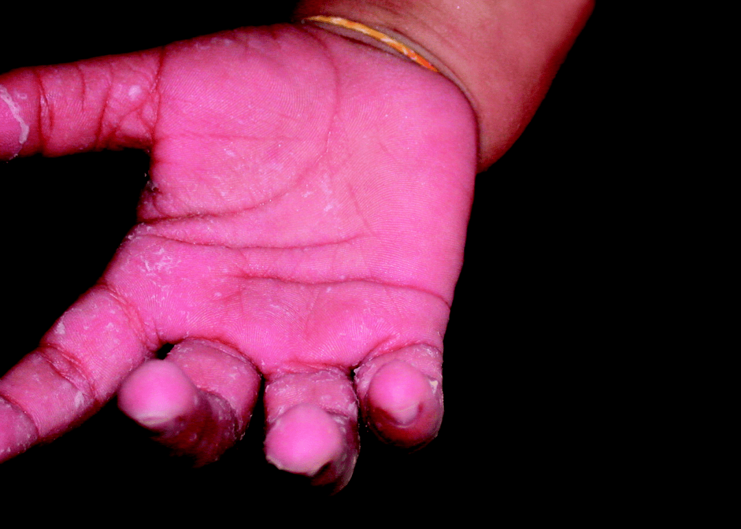 男婴出现皮疹蜕皮出汗丧失爬行能力究竟是什么病