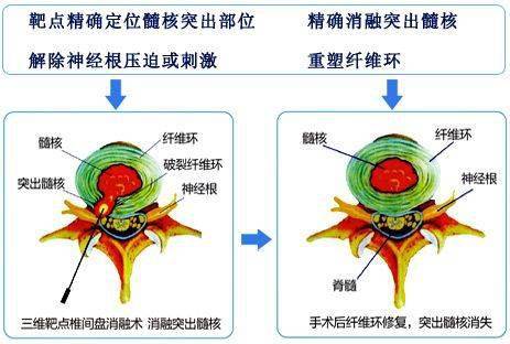 射频消融术原理示意图图片