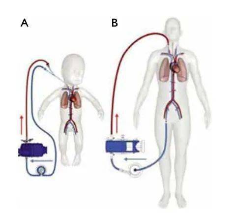 管路、泵、氧合器 |《ECMO——成人的体外生命支持》文章精选_肝素