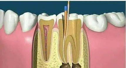 1,根管治疗术并非都是一次完成治疗,往往要根据患者的情况,分次进行