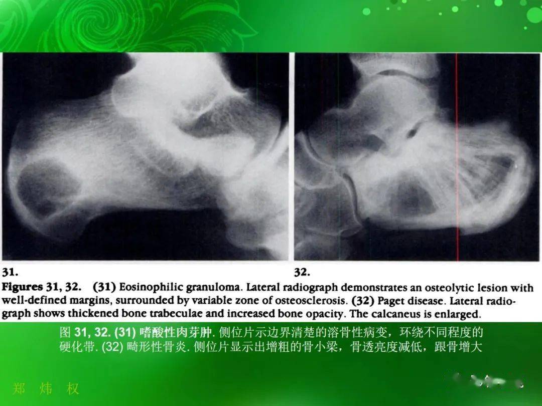 跟骨正常與變異影像學表現_關節