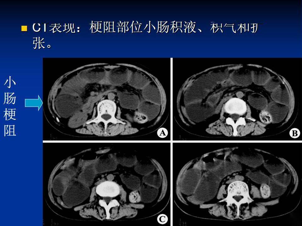 肠梗阻的分类及影像学表现(高清图片 文字讲解)!